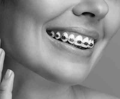 clinica-ortodoncia-invisible-albacete-belmonte