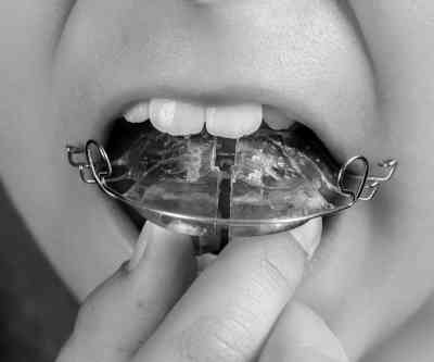 clinica-ortodoncia-invisible-albacete-belmonte