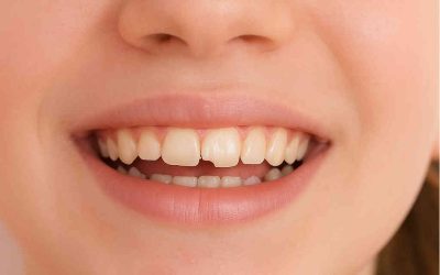 ¡Diente Roto? Tu Clínica Dental en Albacete, Belmonte Centro Avanzado en Odontología, al Rescate